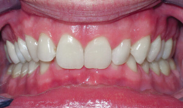 Patient with an overbite
